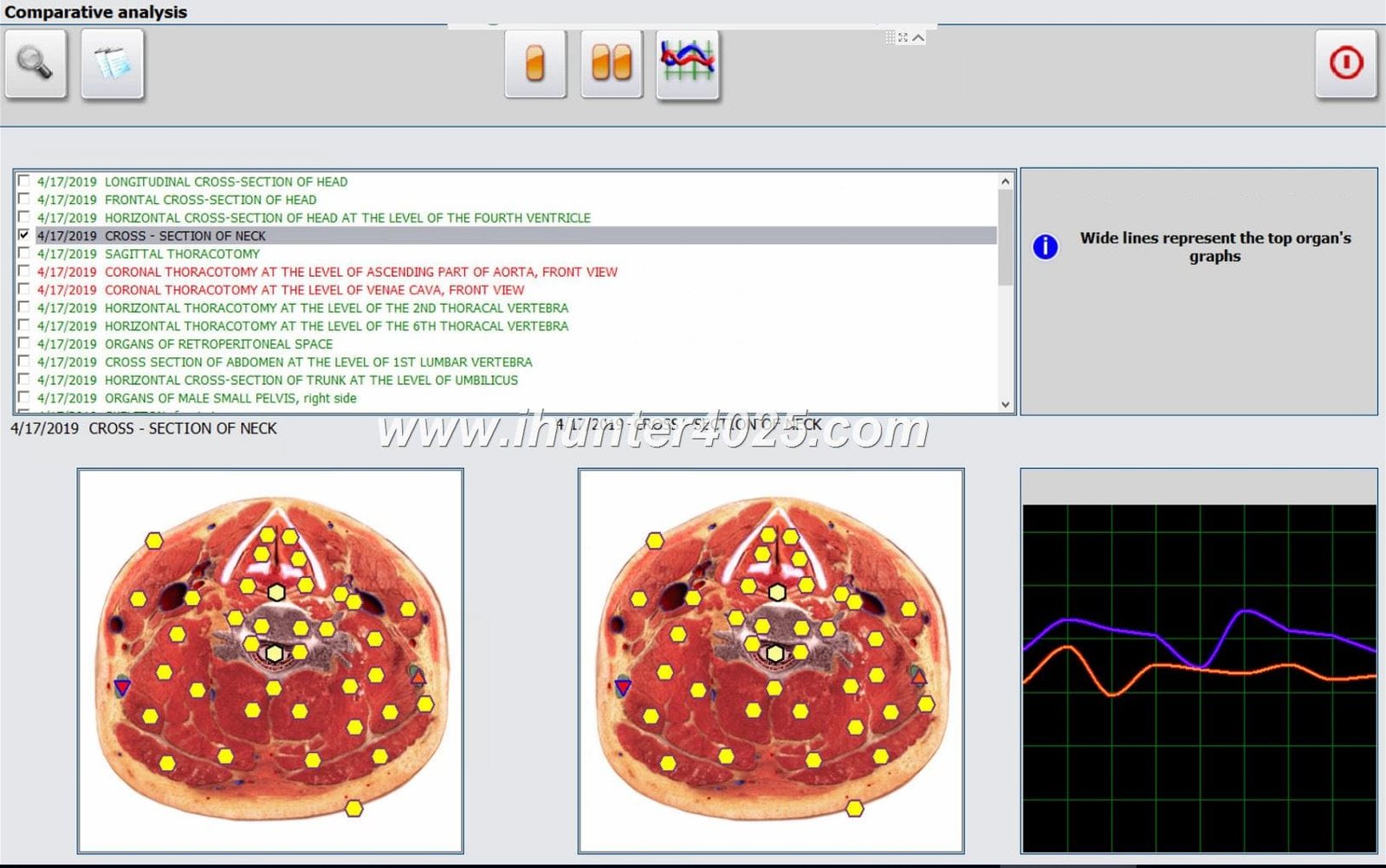 MetatrMetatron Hunter 4025 nls Preton Bioresonance nls Health Diagnostics